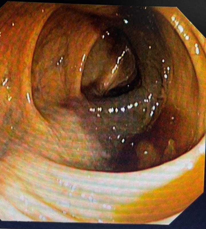 CASE 4: Hemorrhagic Ascending Colon — Ischemic Colitis on Anticoagulation