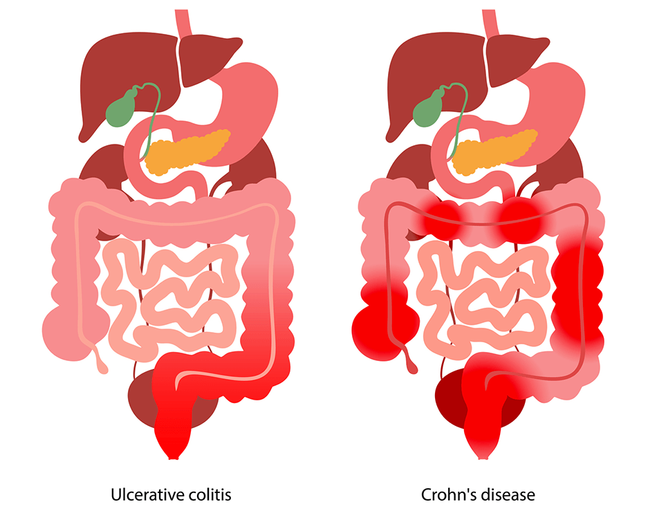 Inflammatory Bowel Disease (IBD) | Johns Hopkins Medicine