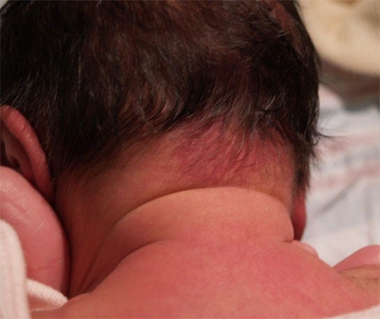 "Stork Bite" Mark