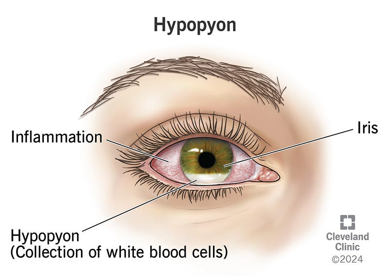 Hypopyon: What It Is, Causes &amp; Treatment