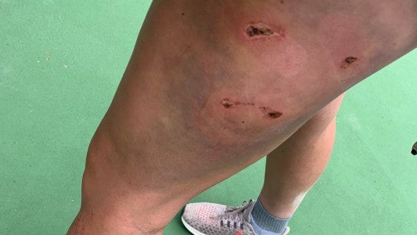 ezra-smith-bear-bite-leg_h.jpg