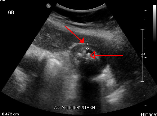 Acute cholecystitis as seen on ultrasound. The closed arrow points to gallbladder wall thickening. Open arrow points to stones in the GB Acute cholecystitis as seen on ultrasound. The closed arrow points to gallbladder wall thickening. Open arrow points to stones in the GB