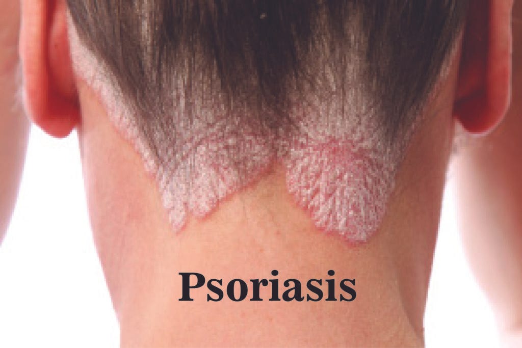 https://www.drankireddy.com/wp-content/uploads/2017/08/Psoriasis-1-1024x683.jpg