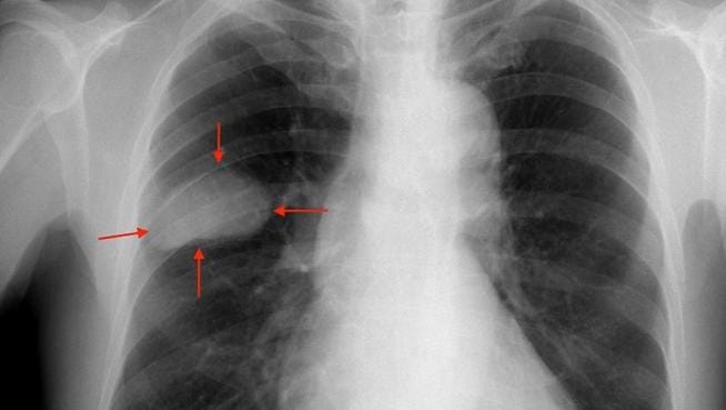 La supervivencia del cáncer de pulmón avanzado empieza a contarse en años