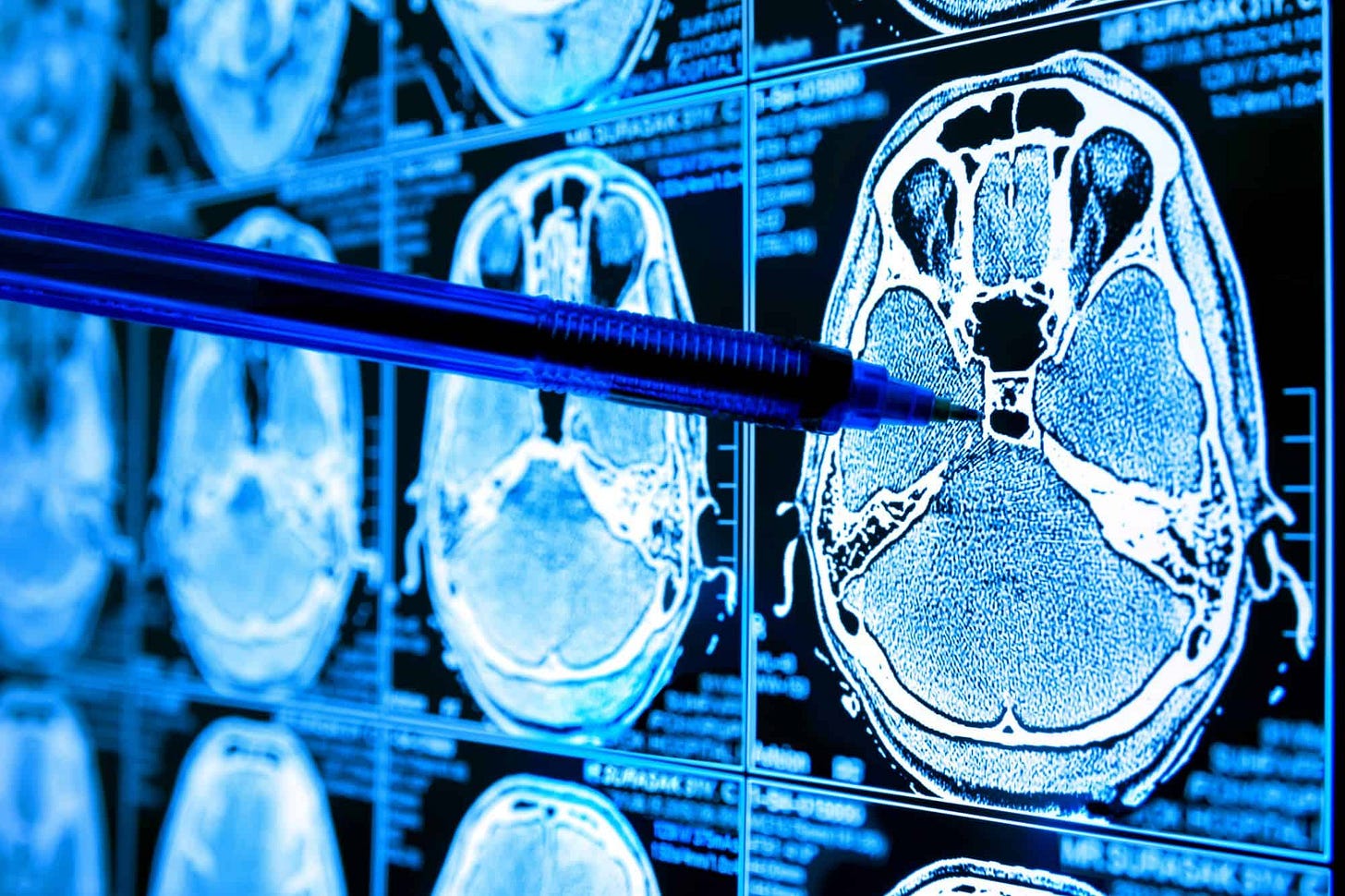ia tumor cérebro