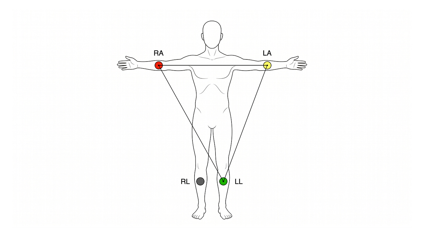 Front-view torso with limb electrodes labelled RA (red), LA (yellow), and LL (green). Three black lines connect the electrodes to form a triangle: RA to LA across the chest, RA to LL diagonally on the right, LA to LL diagonally on the left. The right-leg ground electrode is shown but not connected to the triangle.