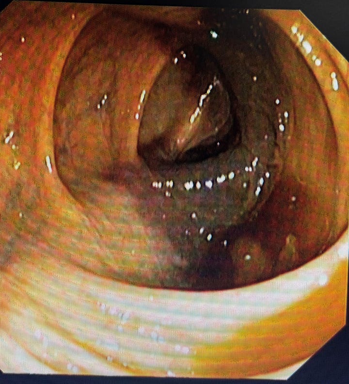 CASE 4: Hemorrhagic Ascending Colon — Ischemic Colitis on Anticoagulation