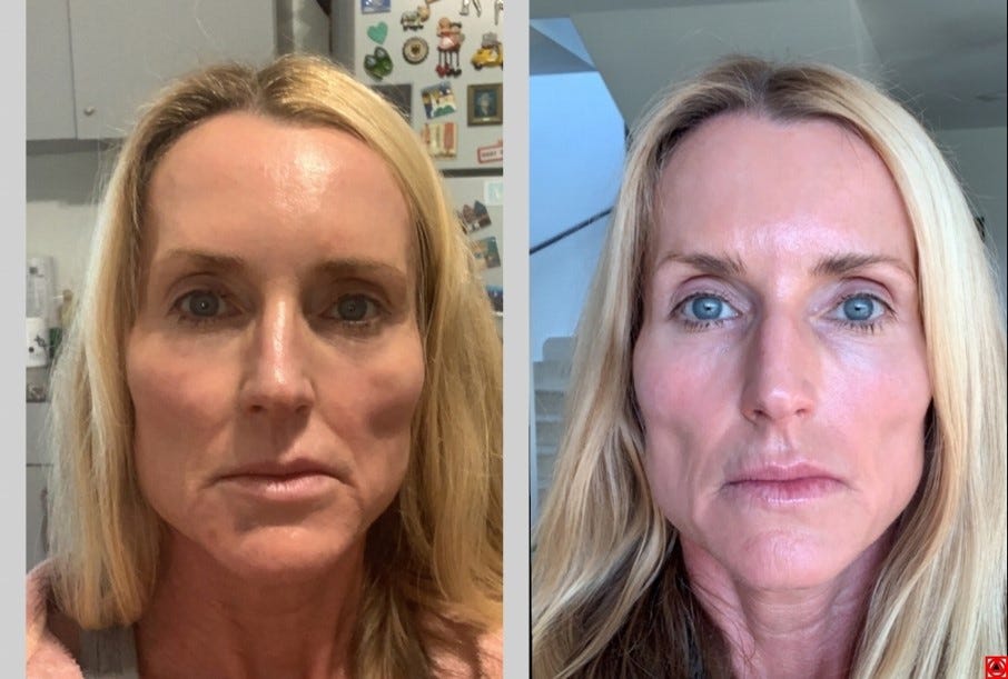 I am worried it will give me a long face (click to see more) - Oralift Ltd  Knowledge Base