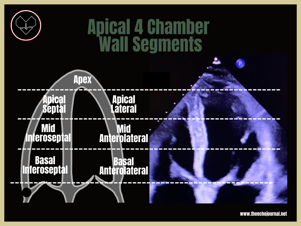 Apical 4 and 5: Technique, Landmarks, and Optimization