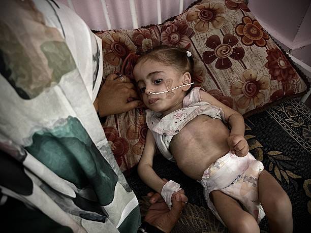 Three-year-old Ibtisam ed-Dali, receiving treatment at Nasir Medical Center in Khan Yunis, struggles with severe malnutrition and epileptic seizures,...