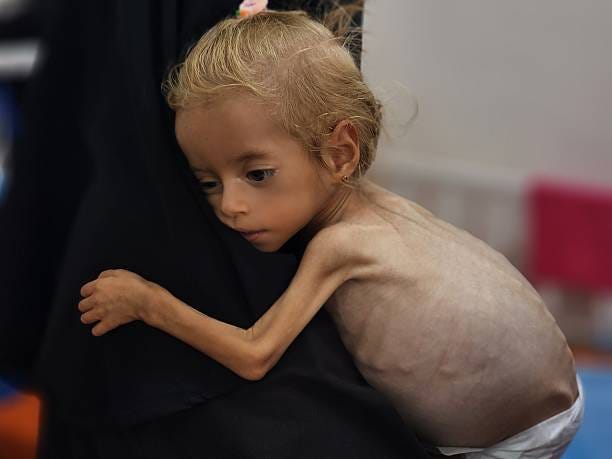Two-year-old Sham Kadih, who is suffering from malnutrition, is treated with limited resources at Nasser Hospital, due to a shortage of formula and...