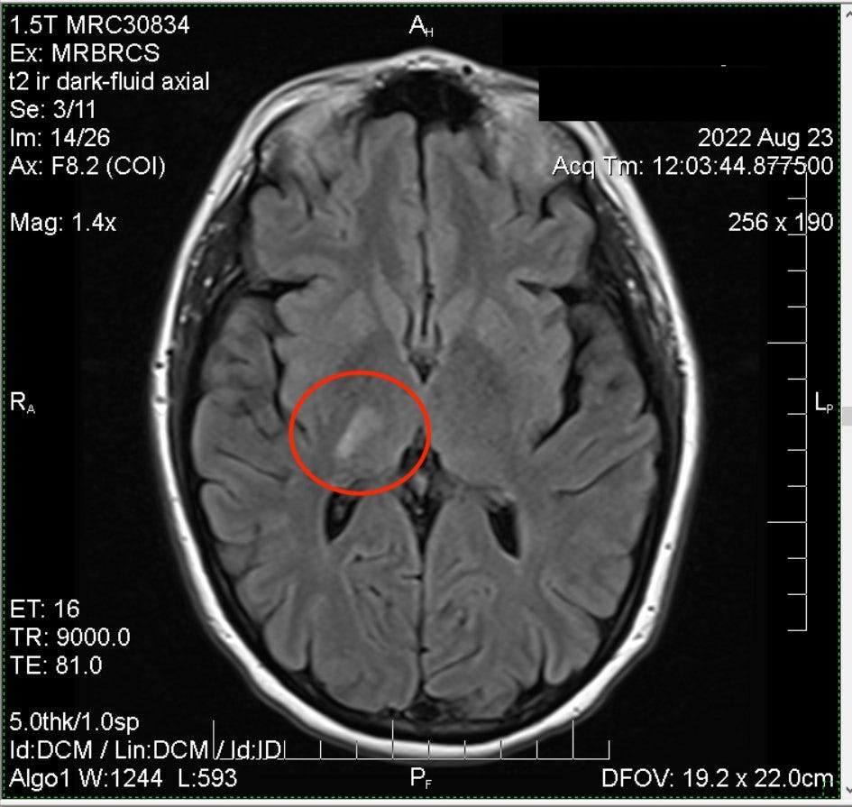 mri image stroke survivor christina berry