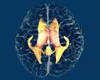 Diffuse Intrinsic Pontine Glioma (DIPG) - Diagnosis ...