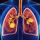 Steroids harmed community-acquired pneumonia patients? (REMAP-CAP)