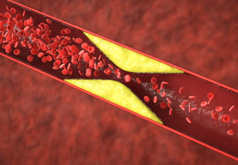 High Cholesterol High Cholesterol