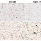 What This Study Found in Lipedema Tissue and Blood