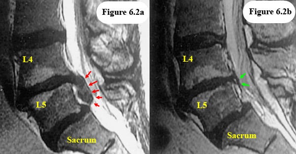 Herniation, Protrusion, & Sipped Disc Advice by a World-Renowned Expert |  ChiroGeek.com