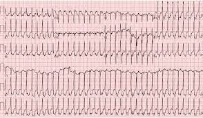 Is SVT an ischaemic arrhythmia? - Resus