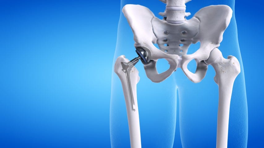 Common Signs You Need a Hip Replacement - Ventura Orthopedics