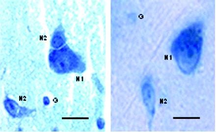 giemsastainingmedialtemporal