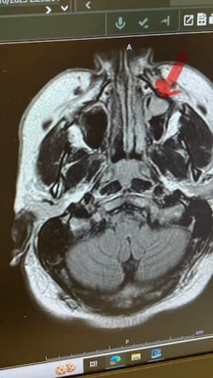 Two images of CT scans showing tumors, and a third image of JP in a hospital bed.