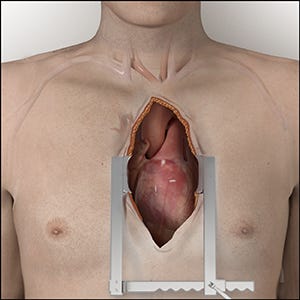 Aortic Valve Replacement Options - Heart Valve Insights