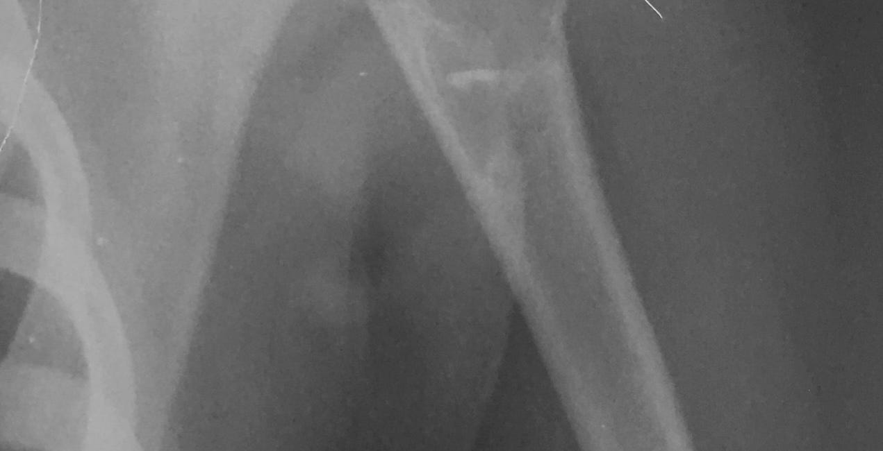 Case 42: Fallen...In the Humerus
