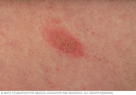 Herald patch of pityriasis rosea Herald patch of pityriasis rosea