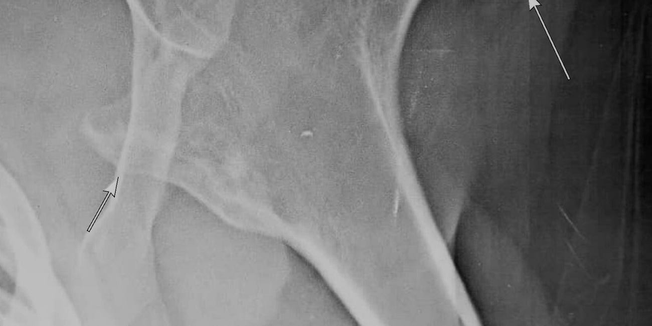 Case 67: Osteochondroma or Chondrosarcoma?