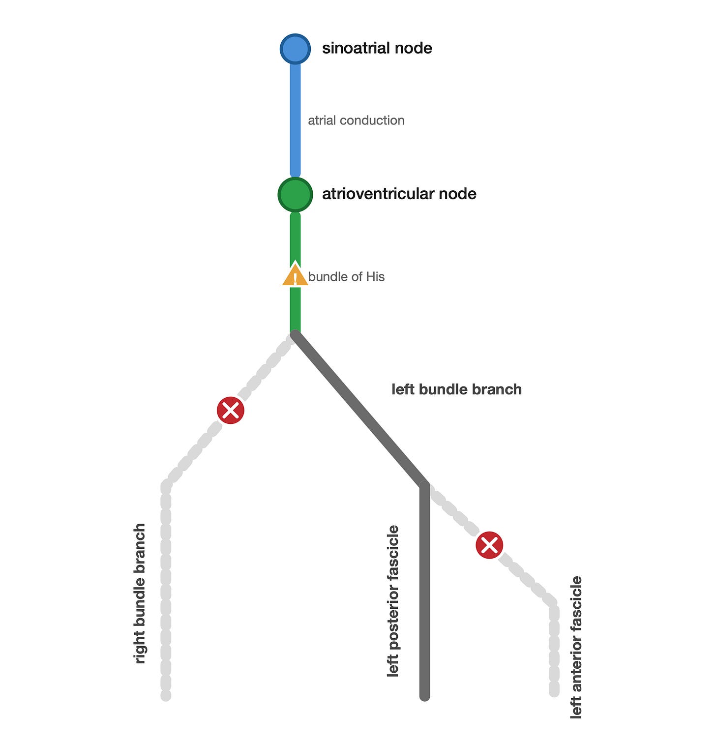 Schematic showing bifascicular block plus 1° AV block: right bundle branch and left anterior fascicle blocked, AV node flagged for delay, left posterior fascicle intact