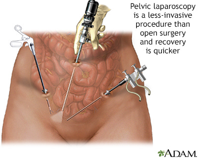 HIE Multimedia - Pelvic laparoscopy