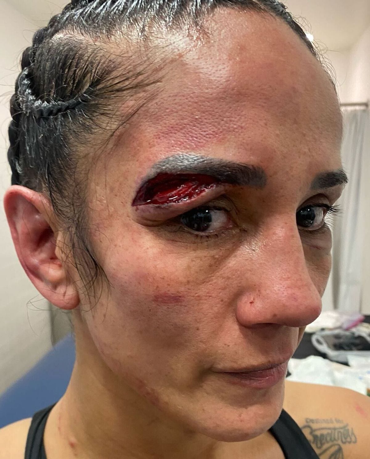 Amanda Serrano shows off gruesome cut suffered from numerous head butts in Katie Taylor rematch - MMA Fighting Amanda Serrano shows off gruesome cut suffered from numerous head butts in Katie Taylor rematch - MMA Fighting