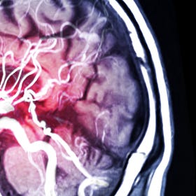 Tenecteplase (TNK) for ischemic stroke after 4 hours