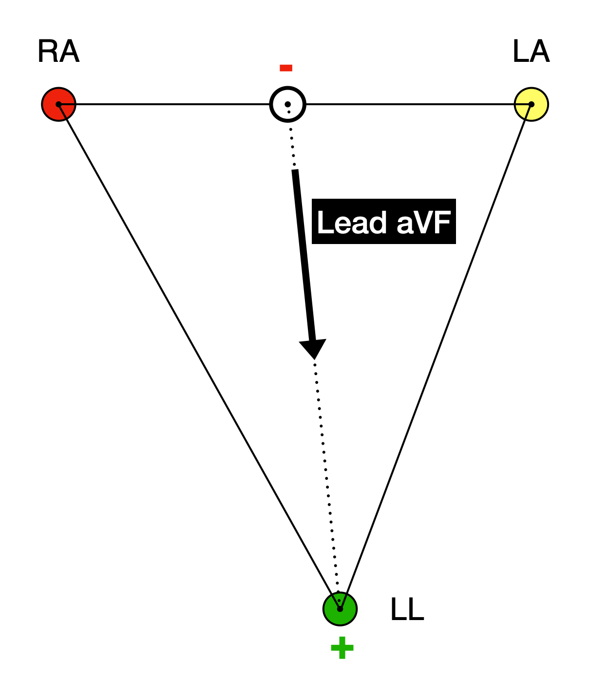 Einthoven's triangle with RA (red), LA (yellow), and LL (green) at the vertices. A small hollow circle sits on the side connecting RA and LA, at its midpoint, marked with a red minus sign. A black arrow runs from this midpoint down to the LL electrode, which is marked with a green plus sign. The arrow is labelled Lead aVF.