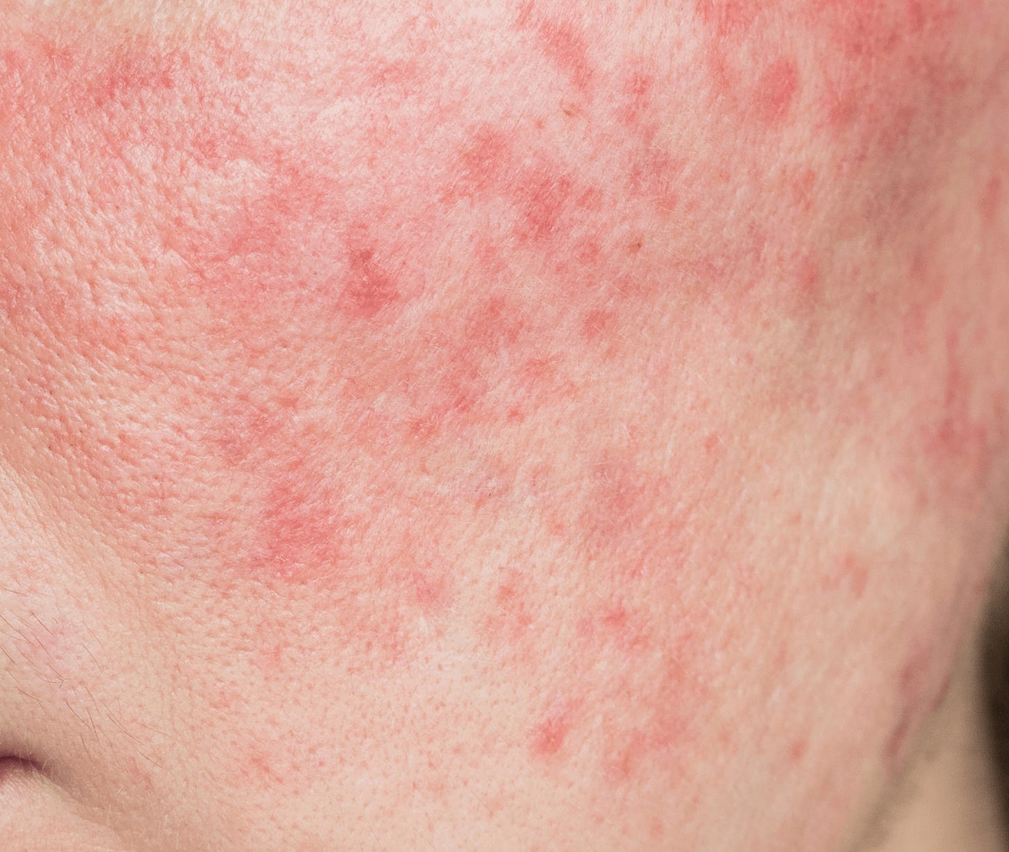 Common Facial Redness Causes & Minimizing Them | Gladskin