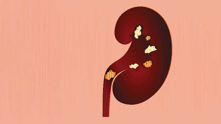 high fat diet risk kidney stones