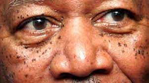 Dermatosis Papulosa Nigra
