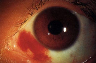 Subconjunctival hemorrhage example - Sione Vaki