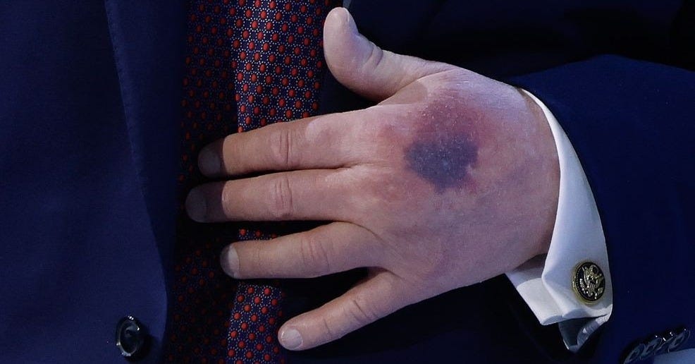 Big bruise spotted on Trump's hand during World Economic Forum