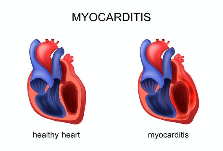 Coronavirus: severe forms of the disease can damage the heart