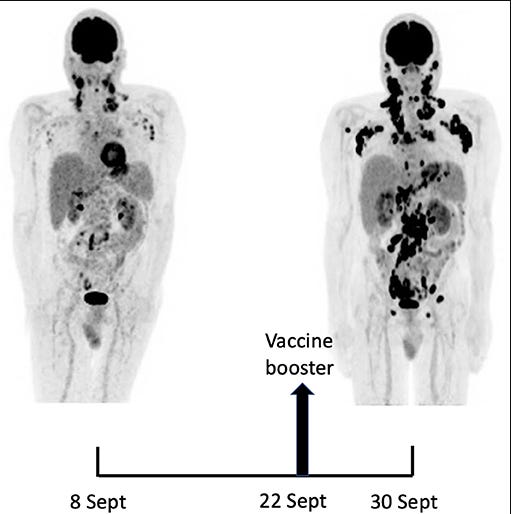 SARS-CoV-2 Vaccination and Oncogenesis
