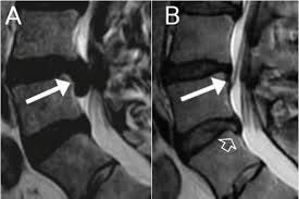 Regression of a large disc herniation ...