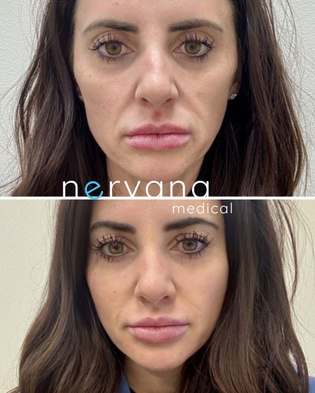 Restoring Facial Volume After Weight Loss: How Collagen-Bio-Stimulators and Hyaluronic Acid Fillers Can Help