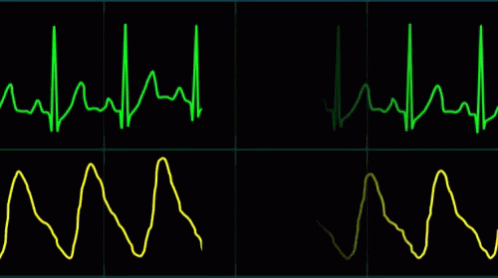 EKG