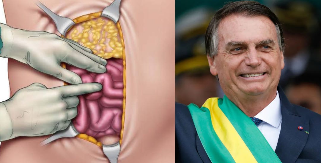 Laparotomia exploradora: o que é, quando é indicada e como é feita