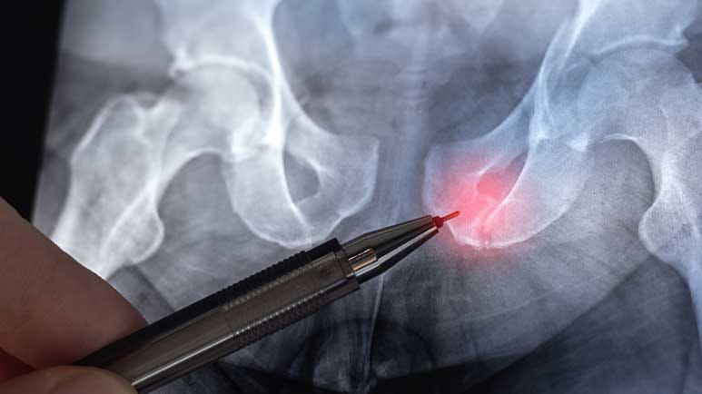 osteoporosis hip fracture prevention