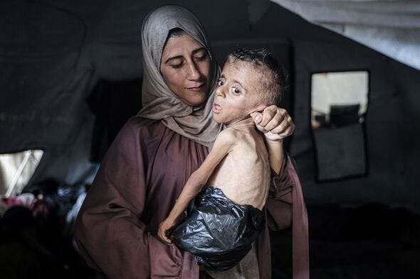 Malnourished toddler Muhammad Zakariya Ayyoub al-Matouq