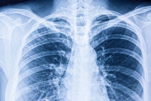 chest x-ray chest x-ray