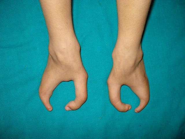 Ectrodactyly or Lobster Claw Hand (and Foot) | Bone and Spine Ectrodactyly or Lobster Claw Hand (and Foot) | Bone and Spine
