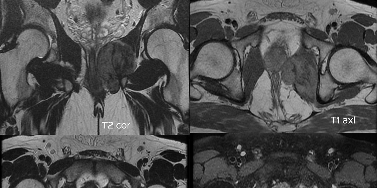 Case 40: A Dark Pelvic Mass